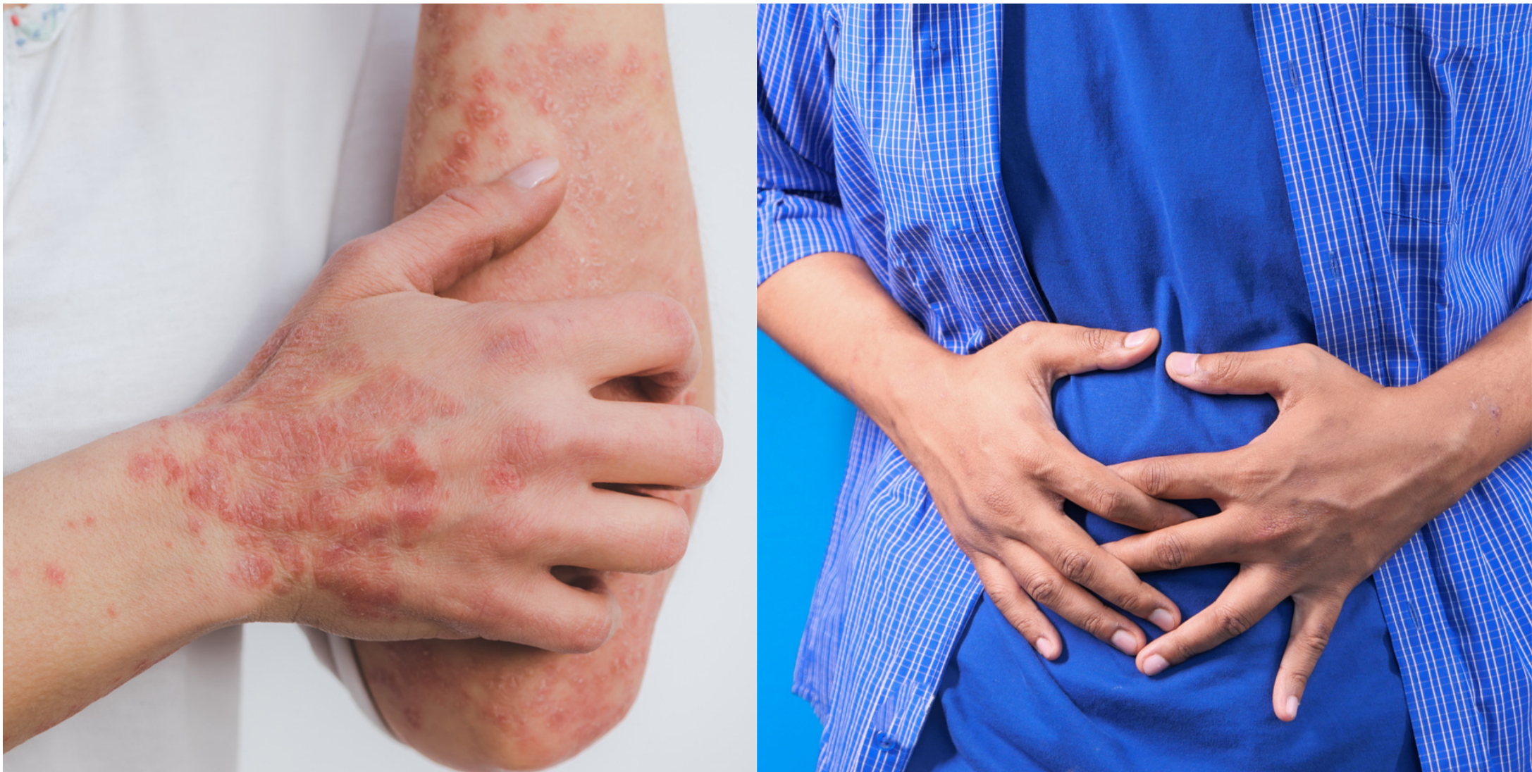 Psoriasis-gen ook gelinkt aan darmgezondheid